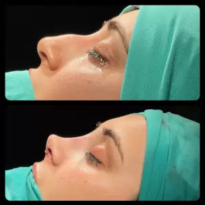 Burun Estetiği Öncesi & Sonrası