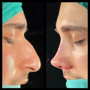 Burun Estetiği Öncesi & Sonrası