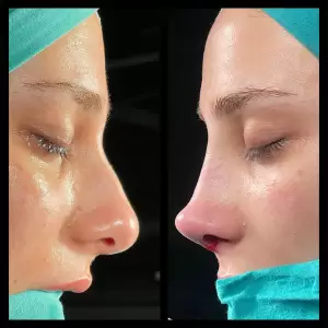 Burun Estetiği Öncesi & Sonrası