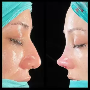 Burun Estetiği Öncesi & Sonrası