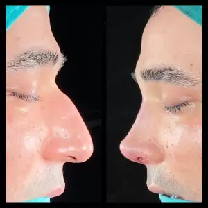Burun Estetiği Öncesi & Sonrası