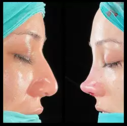 Burun Estetiği Öncesi & Sonrası
