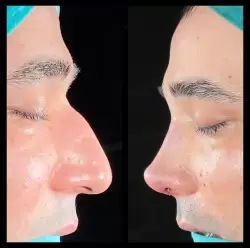 Burun Estetiği Öncesi & Sonrası