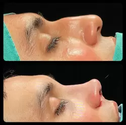 Burun Estetiği Öncesi & Sonrası