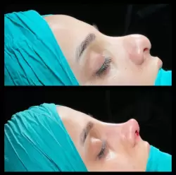 Burun Estetiği Öncesi & Sonrası