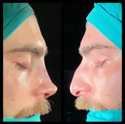 Burun Estetiği Öncesi & Sonrası