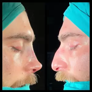 Burun Estetiği Öncesi & Sonrası