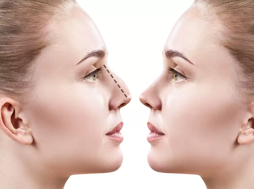 Burun Estetiği Teknikleri Nelerdir? Ameliyatsız Burun Estetiği Var Mı?