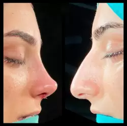 Burun Estetiği Öncesi & Sonrası