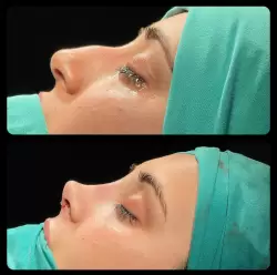 Burun Estetiği Öncesi & Sonrası