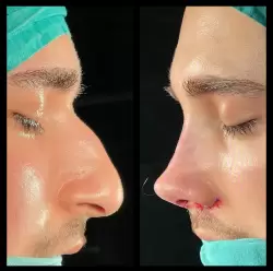 Burun Estetiği Öncesi & Sonrası