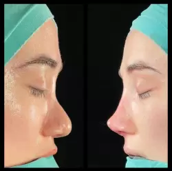 Burun Estetiği Öncesi & Sonrası