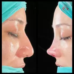 Burun Estetiği Öncesi & Sonrası