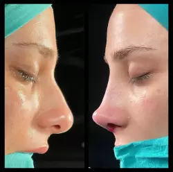 Burun Estetiği Öncesi & Sonrası