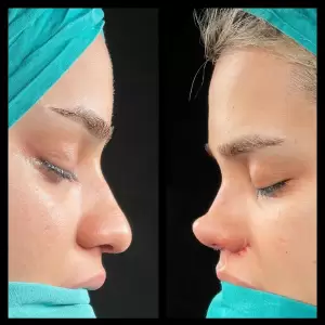 Burun Estetiği Öncesi & Sonrası