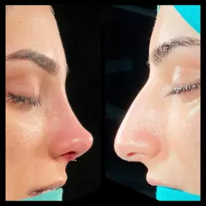 Burun Estetiği Öncesi & Sonrası