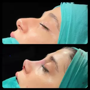 Burun Estetiği Öncesi & Sonrası