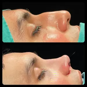 Burun Estetiği Öncesi & Sonrası