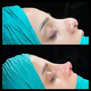 Burun Estetiği Öncesi & Sonrası
