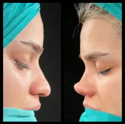 Burun Estetiği Öncesi & Sonrası