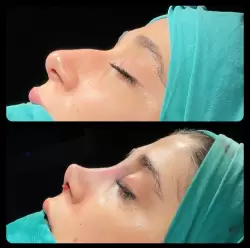 Burun Estetiği Öncesi & Sonrası