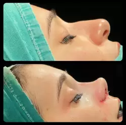 Burun Estetiği Öncesi & Sonrası