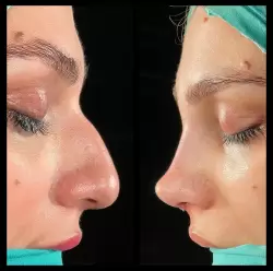 Burun Estetiği Öncesi & Sonrası